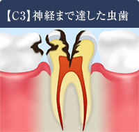 【C3】神経まで達したむし歯